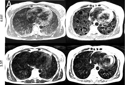 Lung images show increased signal intensity at 0.55 tesla, compared with 1.5 tesla, because of improved field homogeneity, as seen in a healthy 26-year-old woman and a 54-year-old woman with a rare lung disease known as lymphangioleiomyomatosis. Images courtesy of Radiology.