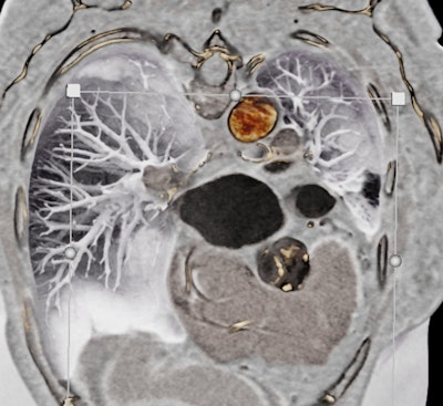 Black-blood CT displaying a calcified aortic valve.