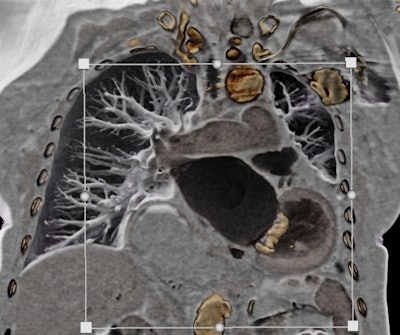 Black-blood CT showing a calcified mitral annulus. The image was generated using cinematic rendering technology. All images courtesy of Dr. Elliot Fishman.