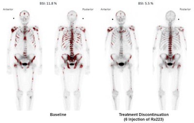 Images show declining aBSI values after six treatments with Ra-223. The artificial neural network preselected skeletal regions (dark red), which were used to calculate the aBSI. Images courtesy of the Journal of Nuclear Medicine.