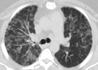 Giant cell interstitial pneumonia attributed to vaping in a 49-year-old woman who presented with one to two years of worsening dyspnea. Axial CT images show relatively symmetric ground-glass opacity and perilobular opacities involving all lobes. Subsequent surgical lung biopsy results were consistent with giant cell interstitial pneumonia. When asked about exposure, the patient said she had begun vaping a tetrahydrocannabinol (THC) mixture around the time her symptoms started. She had no other occupational exposures to heavy metals, and her vape pen was found to have traces of cobalt on subsequent analysis. Images courtesy of the American Roentgen Ray Society.