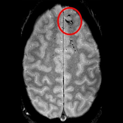 Traumatic microbleeds appear as dark lesions on MRI scans and suggest damage to brain blood vessels after head injury. Image courtesy of Latour Lab/NINDS.