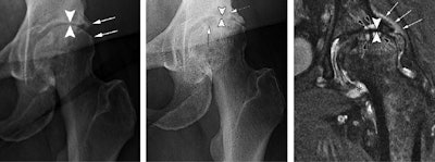 Left: Anteroposterior left hip x-ray of a 61-year-old woman who presented with hip pain shows joint space narrowing (arrowheads) and femoral and acetabular osteophytic changes (arrows) consistent with hip osteoarthritis. Middle: Four months after intra-articular corticosteroid injection, anteroposterior hip radiograph shows severe interval joint space narrowing (arrowheads) and enlarging subchondral cysts (arrows). Right: Coronal intermediate-weighted fat-suppressed MRI obtained at the same time as middle image shows complete loss of the acetabular and femoral cartilage (arrowheads), with subchondral cystic changes (black arrows). In addition, there is joint effusion and synovitis (*) and periarticular soft-tissue edema (white arrows). This patient underwent total joint replacement three months later. Images courtesy of the RSNA.
