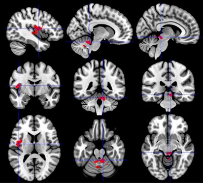 The insula region of the brain (right column) has greater activation in individuals with chronic fatigue syndrome than in healthy controls or those with Gulf War illness. By comparison, the cerebellum (middle column) has less activation in Gulf War illness than healthy controls or those with chronic fatigue syndrome. In addition, the brainstem showed less activation (left column) in Gulf War illness and greater activation in chronic fatigue syndrome. All the differences were observed after exercise. Images courtesy of Stuart Washington, PhD.