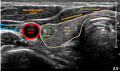 Ultrasound image of thyroid nodule. Image courtesy of Dr. Elizabeth Cottrill, Thomas Jefferson University.