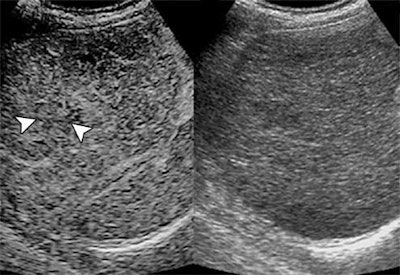 Shown are two ultrasound images of a 69-year-old man with cirrhotic nodule, one contrast-enhanced (left) and one conventional (right). At initial detection, contrast arrival time difference between nodule and liver was 1.87 seconds. At 30.07 seconds, nodule (arrowheads, left image) is isoenhanced compared with surrounding liver. Images courtesy of ARRS.