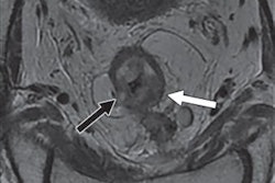 2019 10 25 23 02 2901 2019 10 28 Mri Prostate Ajr Jai