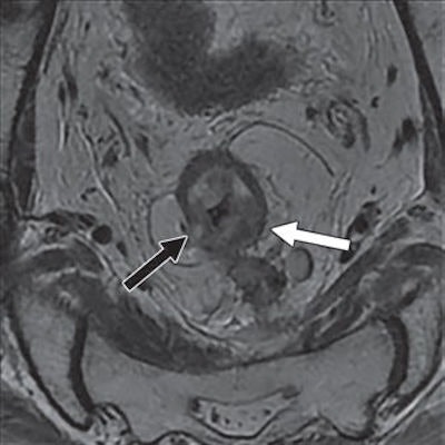 Above: Restaging oblique axial T2-weighted MR image shows small area of high signal intensity (black arrow) within intermediate signal intensity of primary tumor (white arrow), which was interpreted as acellular mucin and tumor regression grade 4. Below: A histologic slice, however, shows only a small number of tumor cells (black arrowheads) scattered in massive fibrosis (white arrowheads) and acellular mucin (arrow). The disease was reclassified as pathologic tumor regression grade 2. Images courtesy of AJR.