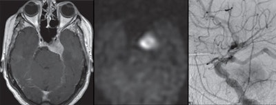 Images are from a 70-year-old woman with left cavernous sinus meningioma. Gadolinium-enhanced T1-weighted MR image shows left cavernous sinus meningioma (left), while arterial spin-labeling MR image (center) reveals increased signal intensity. Digital subtraction angiography (right) shows positive tumor enhancement with feeding vessel arising from middle meningeal artery. Images courtesy of AJR.
