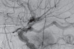 2019 10 28 23 39 0327 2019 10 30 Mri Dsa Meningiomas Thumb