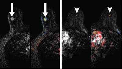 Left: A 48-year-old woman with a 1.3-cm invasive ductal carcinoma (arrow) in the right breast at MRI with color mapping. Right: A 0.5-cm mass (arrow) was seen in the left breast that was biopsy-proven benign. Neither was seen at MBI or CEDM. Images courtesy of Radiology.