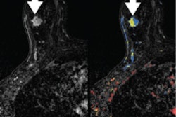 2019 10 30 22 14 6005 2019 10 31 Breast Mri Sumkin 400