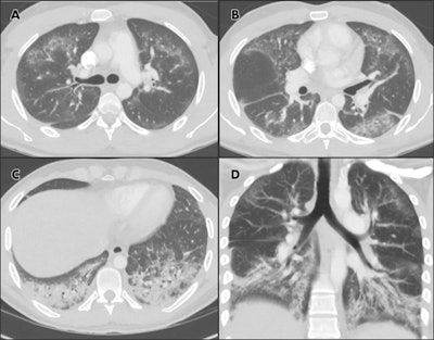 Chest CTA images in 24-year-old man with a history of e-cigarette use. A-C, select axial sections of the lung presented on lung windows reveal patchy ground-glass opacities distributed bilaterally with some, A, B, subpleural sparing and, C, consolidation in the lung bases. D, coronal oblique thick-slab average intensity reconstruction shows the predominance of the findings in the basal lungs and demonstrates the peripheral subpleural sparing. Images courtesy of RSNA.