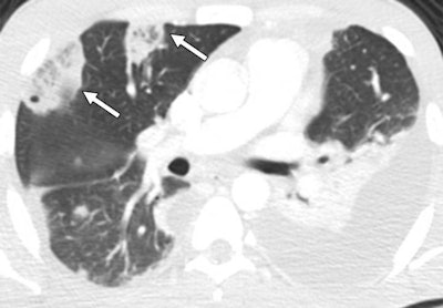 Chest CT scan showing two reversed halo signs (arrows) with central reticulation in the anterior segment of the right upper lobe. Image courtesy of AJR.