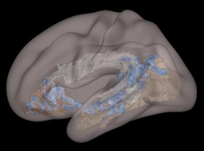White matter showing reduced structural integrity (blue) on the DTI-MR images of a child exposed to significant screen time. Image courtesy of Cincinnati Children's Hospital Medical Center.