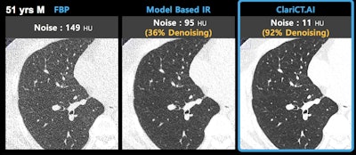 Image demonstrates ClariCT.AI algorithm applied to CT scan acquired at 120 kV and 3 mAs. Image courtesy of ClariPi.