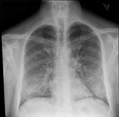 The chest x-ray of a patient with vaping-associated lung injury shows lung opacities, densities, and whitish cloud-like areas common in unusual pneumonias, pulmonary edema, and lung inflammation. Image courtesy of Intermountain Healthcare.