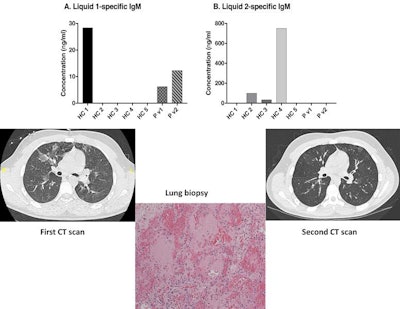 Radiology-immunology-histopathology correlation in a case of hypersensitivity pneumonitis: concentration of liquid 1-specific immunoglobulin M (IgM); concentration of liquid 2-specific IgM. First CT scan: day 6 from first presentation. Second CT scan: day 44 from first presentation. Lung biopsy showing inflammation and hyaline membrane formation. Images courtesy of Dr. Jayesh Mahendra Bhatt and Arch Dis Child.