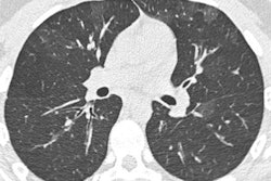 2019 11 11 18 54 9898 Vaping Ct Inflammation 400