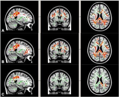 DTI-MR images show white-matter regions with significant preseason to postseason reduction in mean diffusivity (A), axial diffusivity (B), and radial diffusivity (C) among high school football players. Images courtesy of the Clinical Journal of Sport Medicine.