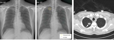Images of a 62-year-old man with primary adenocarcinoma. Left and middle: Posteroanterior digital chest radiographs. Left: Without DCNN software assistance, three readers interpreted this image as a normal chest radiograph. Middle: According to the DCNN's suggestion (dotted circle), all readers were able to identify a true nodule (yellow circle). Right: Axial CT image obtained on the same day shows a 25-mm solid mass in the apical segment of the right upper lobe (arrow). Images courtesy of the RSNA.