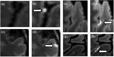Images show examples of leptomeningeal enhancement in relapsing-remitting MS subjects as detected by 3D fluid-attenuated inversion-recovery (FLAIR) sagittal sequences at 7-tesla MRI. Pre- (a, c, e, g) and postcontrast (b, d, f, h) images showing representative foci of leptomeningeal enhancement arrows. Characteristic nodular leptomeningeal enhancement foci (b, d; arrows) found within a sulcus (b) and at the pial surface (d). Spread/fill leptomeningeal enhancement focus examples (f, h), with contrast layering within the sulcal depth (arrows). Images courtesy of Brigham and Women’s Hospital and the Multiple Sclerosis Journal.