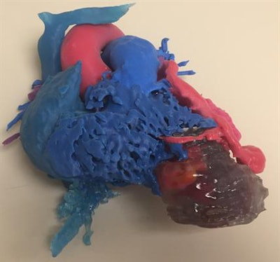 3D-printed heart based on the MR images of a woman with a coronary cameral fistula connected to a double-chambered right ventricle. Image courtesy of Dr. David Ballard.