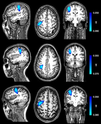 Coregistereed images showing the spatial signature of beta modulation; the largest peak was found in precentral-sulcus (motor cortex) in all three subjects. Image courtesy of Hill et al. Licensed under CC BY-NC 4.0.