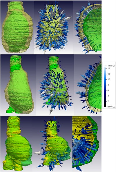 Biomechanical strain analysis of patient CTA scans. Aneurysms with an unfavorable prognosis are depicted as 3D models with arrows pointing away from the aorta (top, middle). The arrows point toward the aneurysm when indicating a favorable prognosis (bottom). Image courtesy of Pompeu Fabra University.