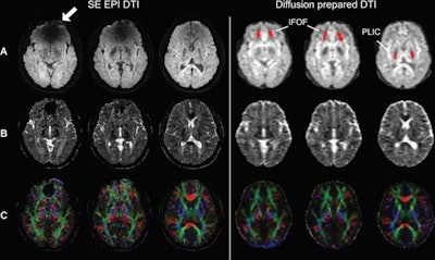 Spin-echo (SE) echo-planar imaging (EPI) and diffusion-prepared diffusion tensor imaging (DTI) axial images acquired at 3 tesla in a subject with metal braces. Shown as raw diffusion-weighted images (A), calculated apparent diffusion coefficient maps (B), and a color-coded fractional anisotropy map (C). Susceptibility artifacts were observed on SE EPI in regions close to braces (arrow). No obvious artifacts were seen on diffusion-prepared DTI. Regions of interest also are indicated in the inferior fronto-occipital fasciculus (IFOF) and posterior limb of internal capsule (PLIC) for quantitative analysis diffusion-prepared DTI (red). Images courtesy of Radiology.
