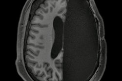 2019 11 18 23 45 7397 2019 11 19 Mri Hemisphere Removed 400
