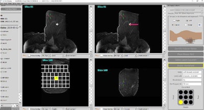 QuantX MRI guidance breast biopsy software plugin. Image courtesy of Qlarity.