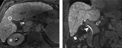 Images from 3-tesla MRI acquired 20 minutes after gadoxetic acid administration in a 61-year-old man with alcohol-induced cirrhosis and a FLIS of 6. His liver parenchymal enhancement quality score was 2, due to higher signal intensity of the liver (circle) compared with the right kidney (*). Excretion quality score is 2 from contrast media in the common bile duct (arrowhead). Portal vein sign quality score was 2 because the portal vein (arrow) was hypointense to the liver parenchyma. Images courtesy of Radiology.
