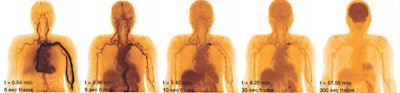 Dynamic study of a subject with bolus injection of F-18 FDG. Images at different time points over one hour illustrate the temporal uptake of FDG, moving from the circulatory system to the organ systems. Such a dynamic study is only possible using a scanner with a long axial FOV.