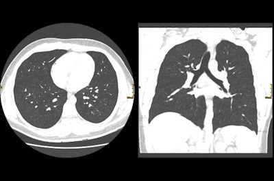 CT scans of a 17-year-old male with EVALI on the first day of hospital admission. The scans show diffuse bronchiolitis as indicated by the many 'tree-in-bud' opacities seen throughout both lungs. All images courtesy of the Canadian Medical Association Journal.