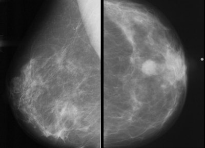 Examples of normal (left) and abnormal (right) mammograms. All images courtesy of the RSNA.