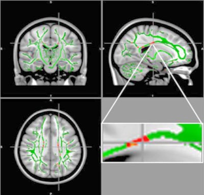 DTI shows reduction in fractional anisotropy in obese patients and control subjects. At the intersection of the alignment vectors, a large cluster of decreased fractional anisotropy is observed in the corpus callosum (red) on the left in obese patients, compared with the control subjects. In addition, there is a reduction in fractional anisotropy and fractional anisotropy skeleton (green) superimposed on the mean fractional anisotropy in sample. Images courtesy of RSNA.