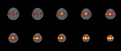 fMRI scan of resting-state networks acquired as part of the study. Image courtesy of the RSNA.