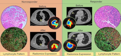CT radiomic patterns showing higher density of tumor infiltrating lymphocytes on diagnostic biopsies after initiation of checkpoint inhibitor therapy (responder, right), compared with before (nonresponder, left). Image courtesy of Case Western Reserve University.