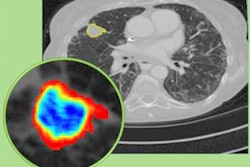 2019 11 26 17 18 6577 2019 11 26 Ct Radiomics Immunotherapy Thumb