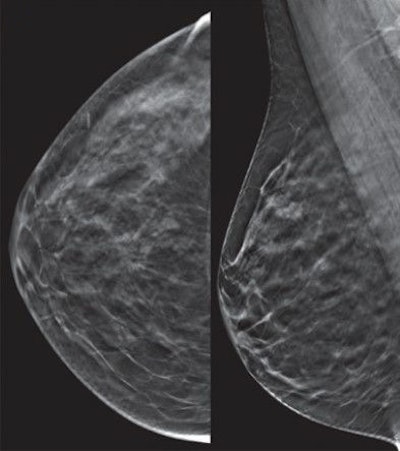 A 50-year-old woman with negative tomosynthesis. Representative craniocaudal and mediolateral oblique 1-mm tomosynthesis images show heterogeneously dense parenchyma in the upper outer quadrant. Two observers (as part of a research study) called this negative, BI-RADS 1. The patient's mother had breast cancer at age 50, as did her maternal great grandfather at age 60. All images courtesy of Dr. Wendie Berg, PhD, and the Journal of Breast Imaging.