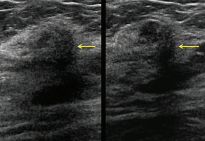 Same patient as above. Screening handheld ultrasound images show this vague indistinctly marginated mass in the right breast at 12 o'clock, 3 cm from the nipple (yellow arrows), assessed as negative by one observer and BI-RADS 4B by the second observer. Ultrasound-guided core biopsy showed invasive lobular carcinoma.