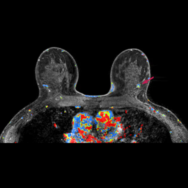Add Mri Add MRI to breast screening for fewer interval cancers | AuntMinnie