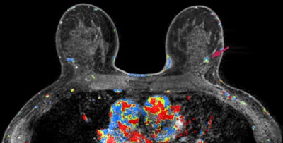 An MRI screening with a possible breast abnormality in the left breast (right side of the picture). Image courtesy of Carla van Gils, PhD.