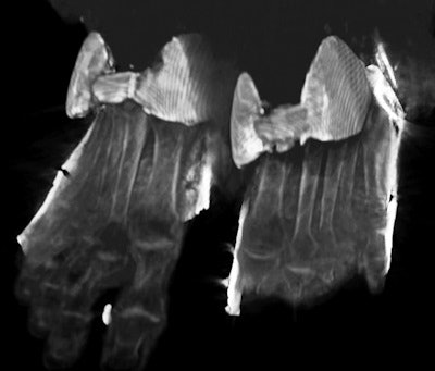 A 3D CT image of the golden sandals worn by Thuya that were hidden beneath her wrappings -- a discovery made by Saleem from this CT study.