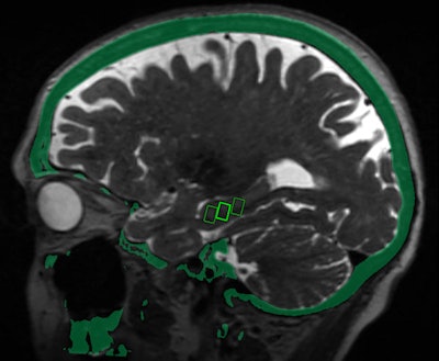 Fused MRI and CT image shows the three targeted sites in the brain's hippocampus, which provides a person's memory function and is adversely affected by Alzheimer's disease. Image courtesy of the RSNA.