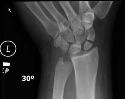 X-ray image of a fractured scaphoid bone in the left wrist due to an electric scooter accident. Image courtesy of RSNA.