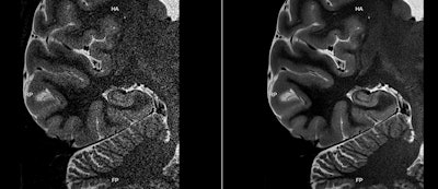 MR images acquired on a 3-tesla Galan scanner before (left) and after (right) data reconstruction with Canon's AiCE protocol. Images courtesy of Canon.