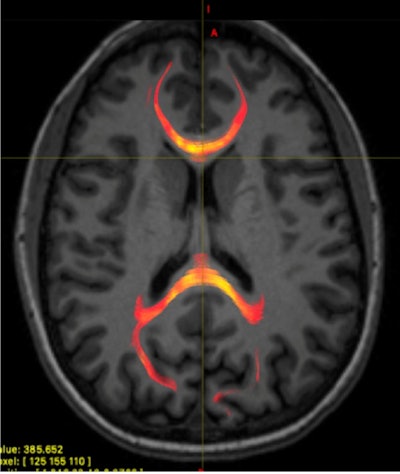 MR image from a patient with mild traumatic brain injury demonstrating corpus callosum fiber tractography, which is a 3D reconstruction of white-matter fibers. This image specifically provides information on the axonal water fraction. Image courtesy of the RSNA.