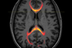 2019 12 01 20 34 0306 Mri Corpus Callosum Concussion Rsna 400